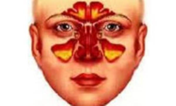 سینوزیت(عفونت سینوس هاى سر و صورت)